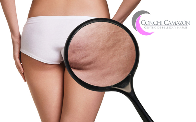 Celulitis. Causas, Formación y ¡Tratamientos para combatirla!